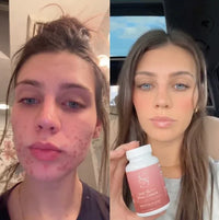 Clear Skin+ Max Detox™ | Full Detox Protocol