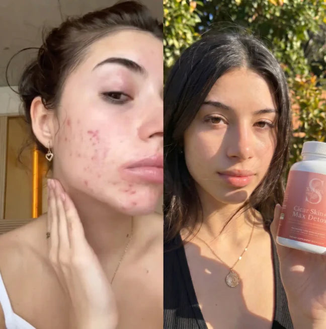 Clear Skin+ Max Detox™ | Full Detox Protocol