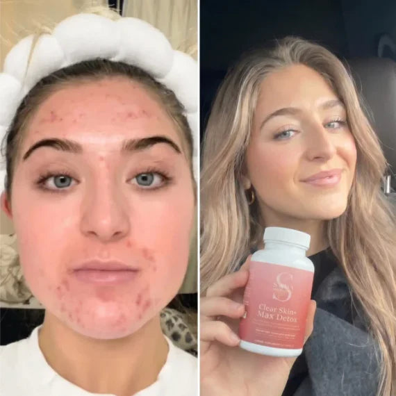 Clear Skin+ Max Detox™ | Full Detox Protocol