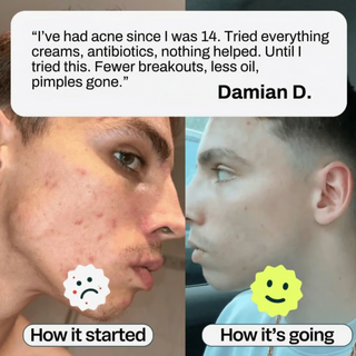 Clear Skin+ Max Detox™