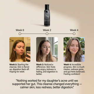 Charcoal+ Acne Cleanser™