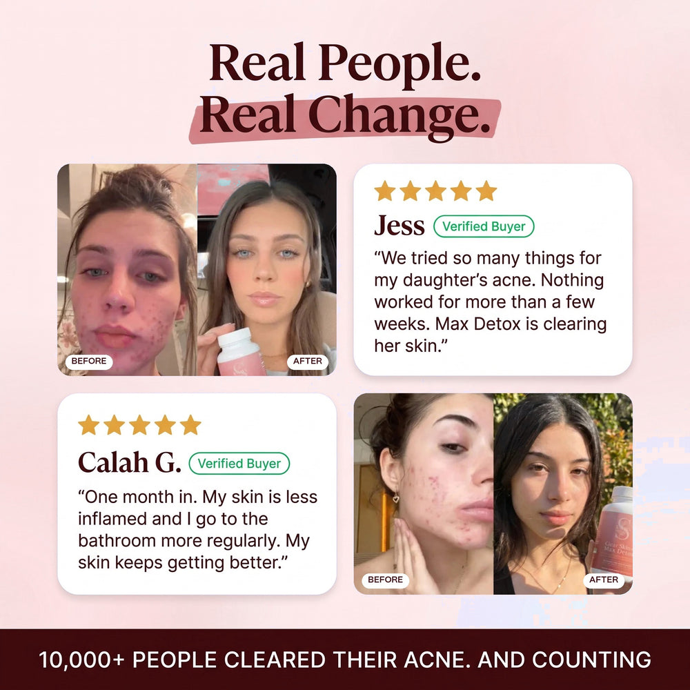 Clear Skin+ Max Detox™ | 4-Stage Acne Clearing Protocol