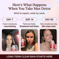 Clear Skin+ Max Detox™ | 4-Stage Acne Clearing Protocol