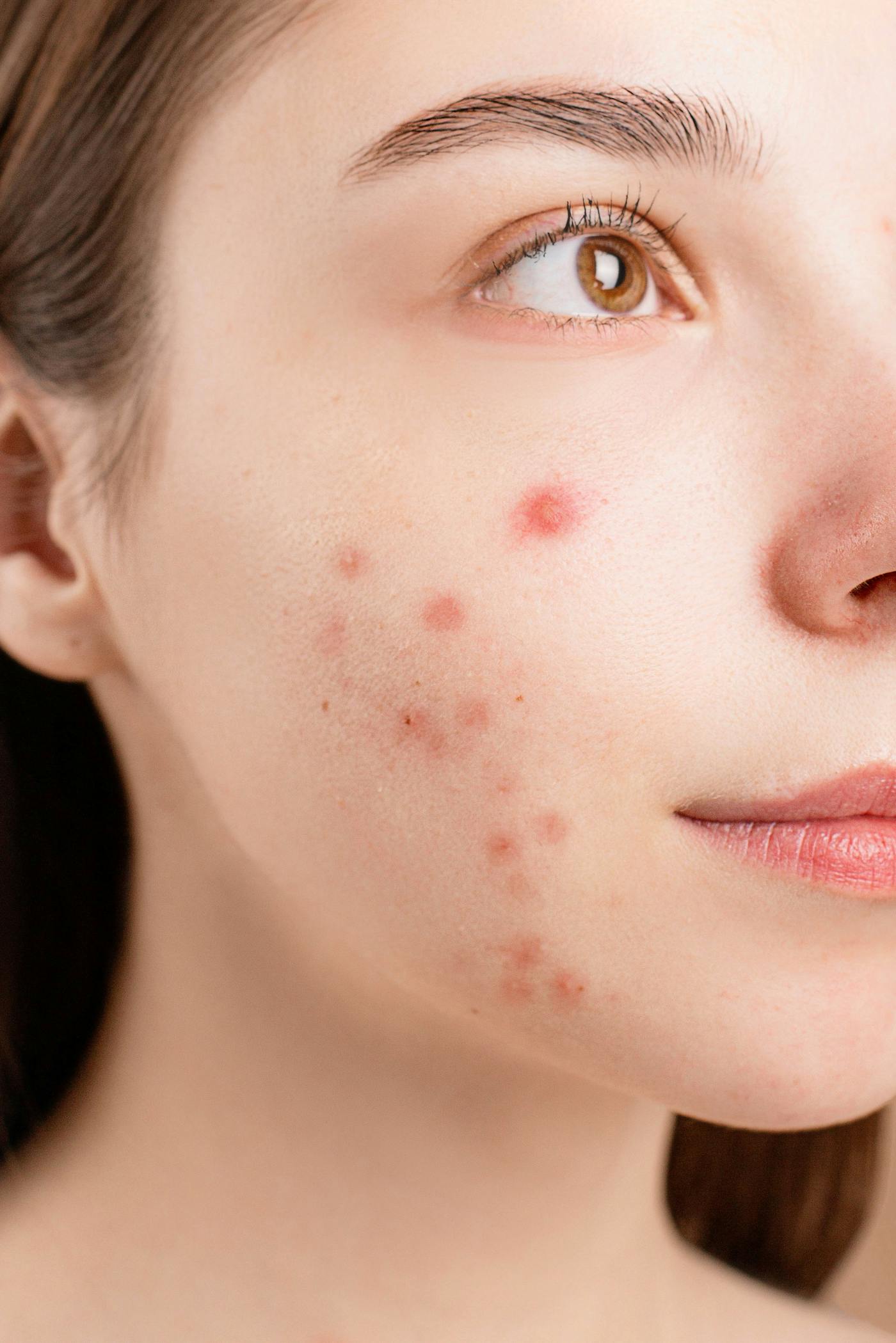 real photo of a woman with jawline acne