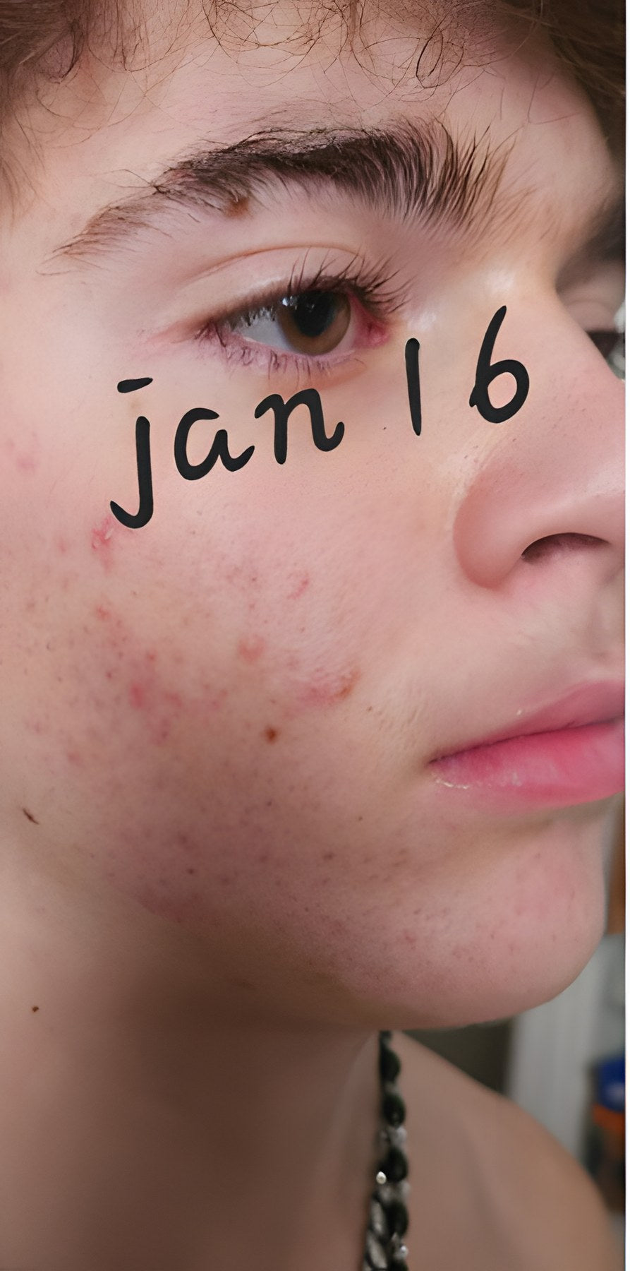 Before Clear Skin+ Gut Cleanse™