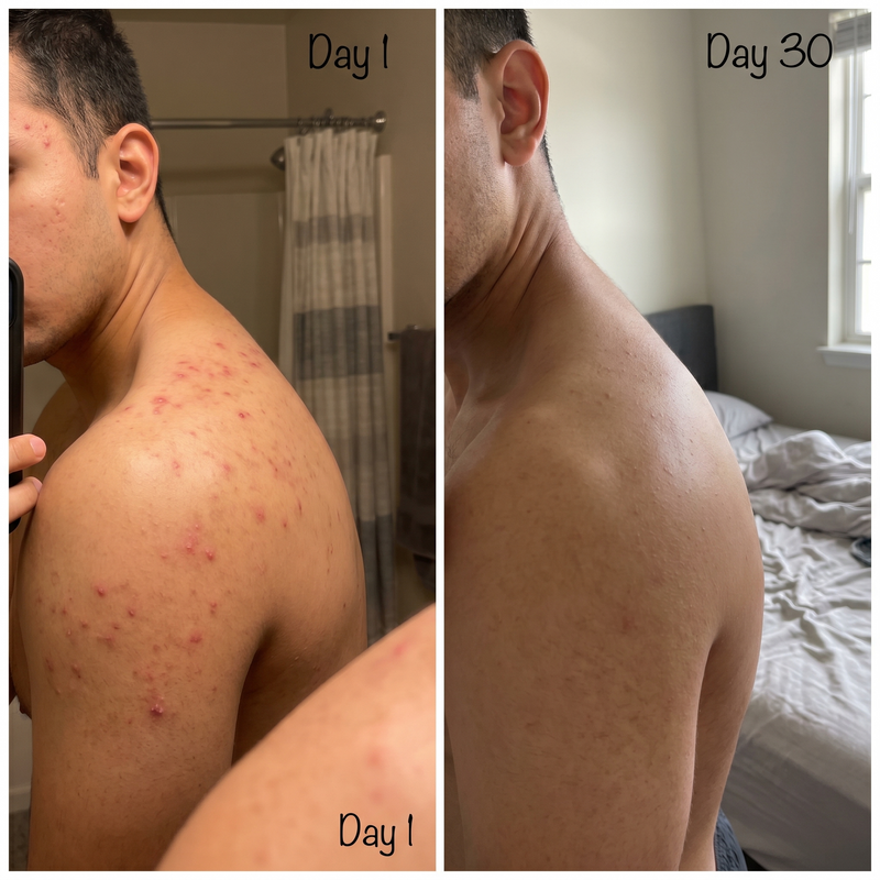 Back body acne bacne before after