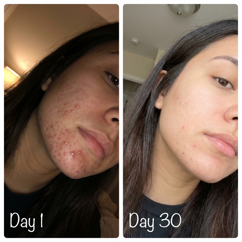 Comedonal chin acne before after