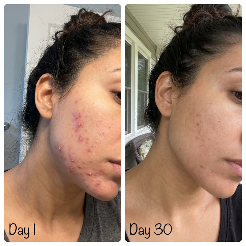 Hormonal jawline acne before after