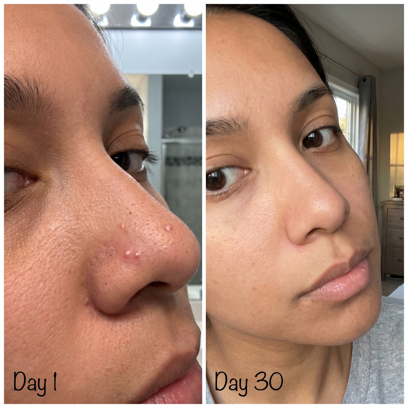 Nose T-zone blackheads before after