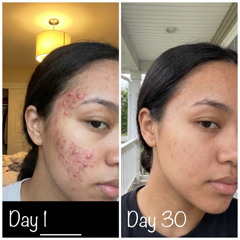 Teen temple acne before after