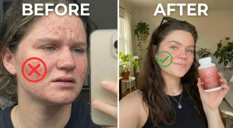 Before and after: clearer skin