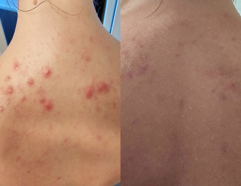 Jess, back acne before and after the 3-month protocol