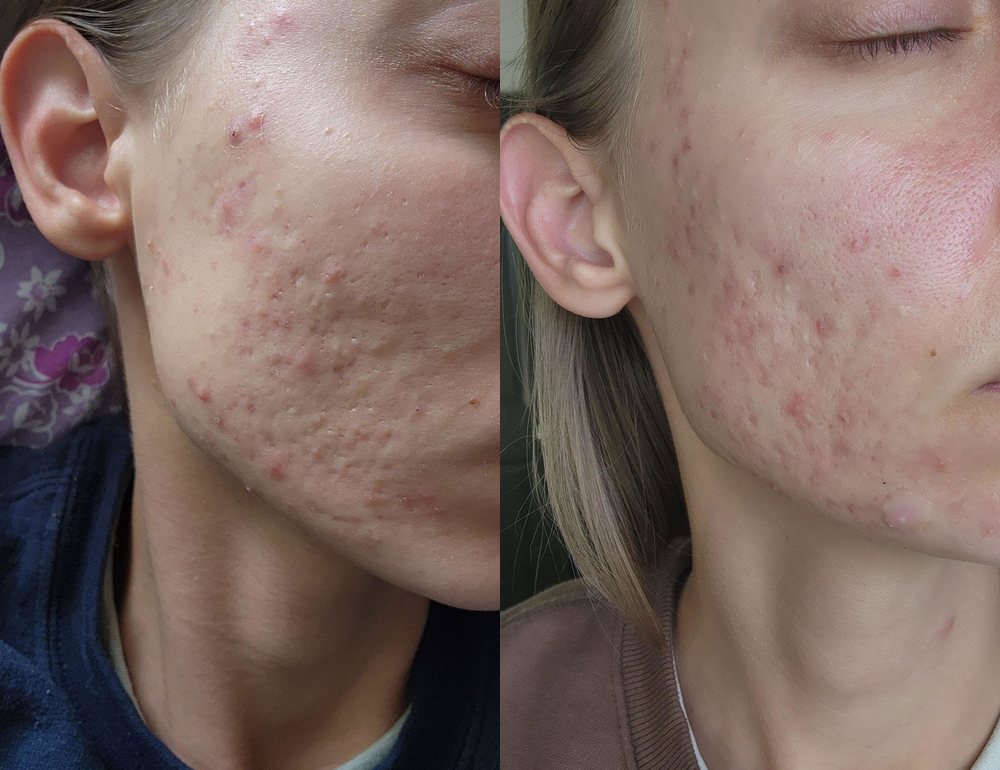 Customer cheek before and after one month